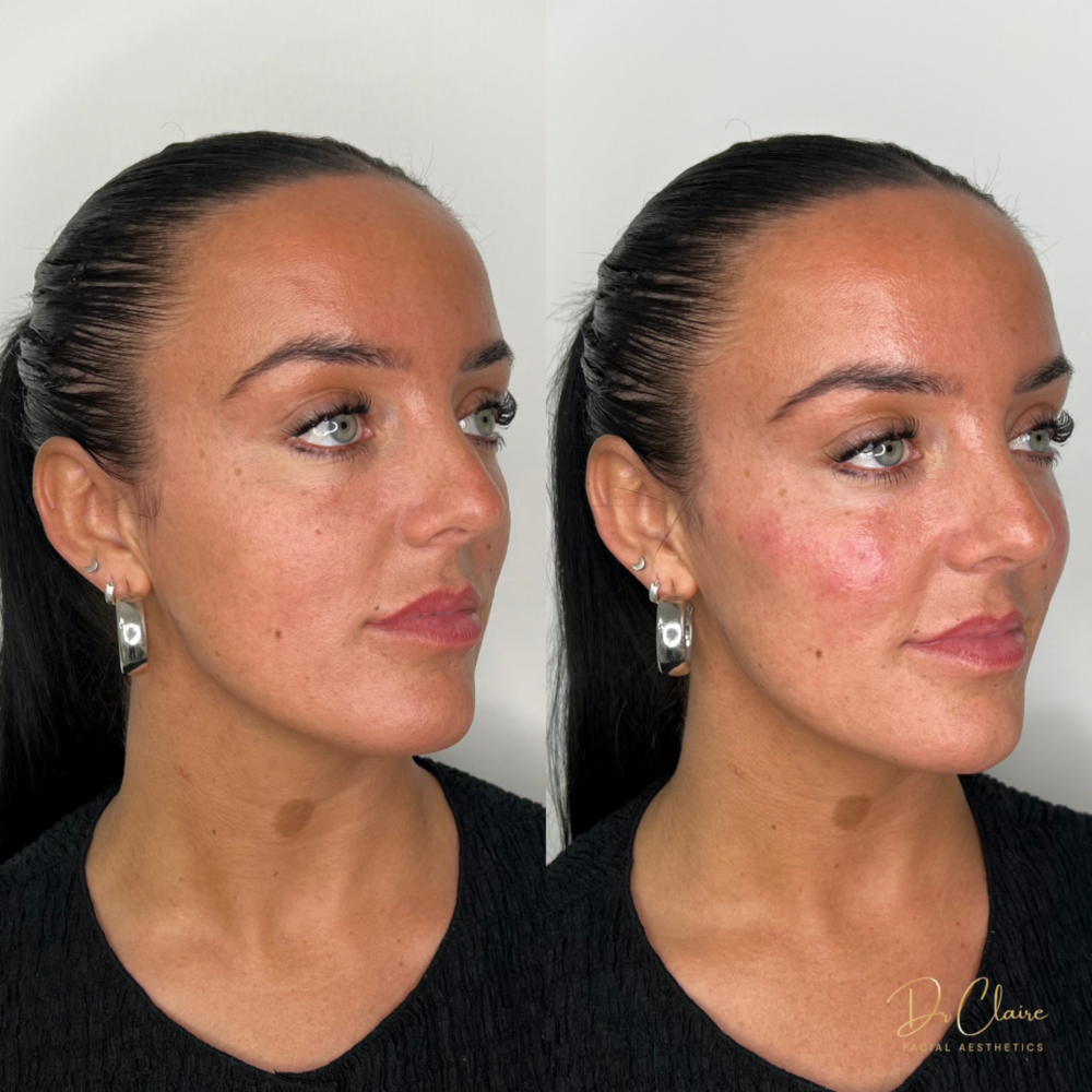 Transformations | Dr Claire Facial Aesthetics | Botox Chorley | Fillers Chorley | Aesthetics Chorley | Botox Treatments Chorley | Dermal Fillers Chorley | Aesthetic Enhancements Chorley