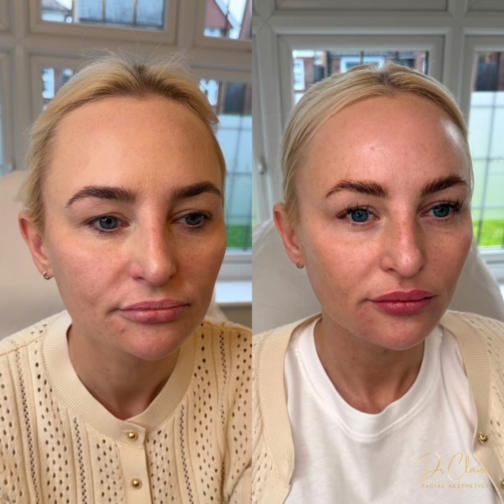Transformations | Dr Claire Facial Aesthetics | Botox Chorley | Fillers Chorley | Aesthetics Chorley | Botox Treatments Chorley | Dermal Fillers Chorley | Aesthetic Enhancements Chorley