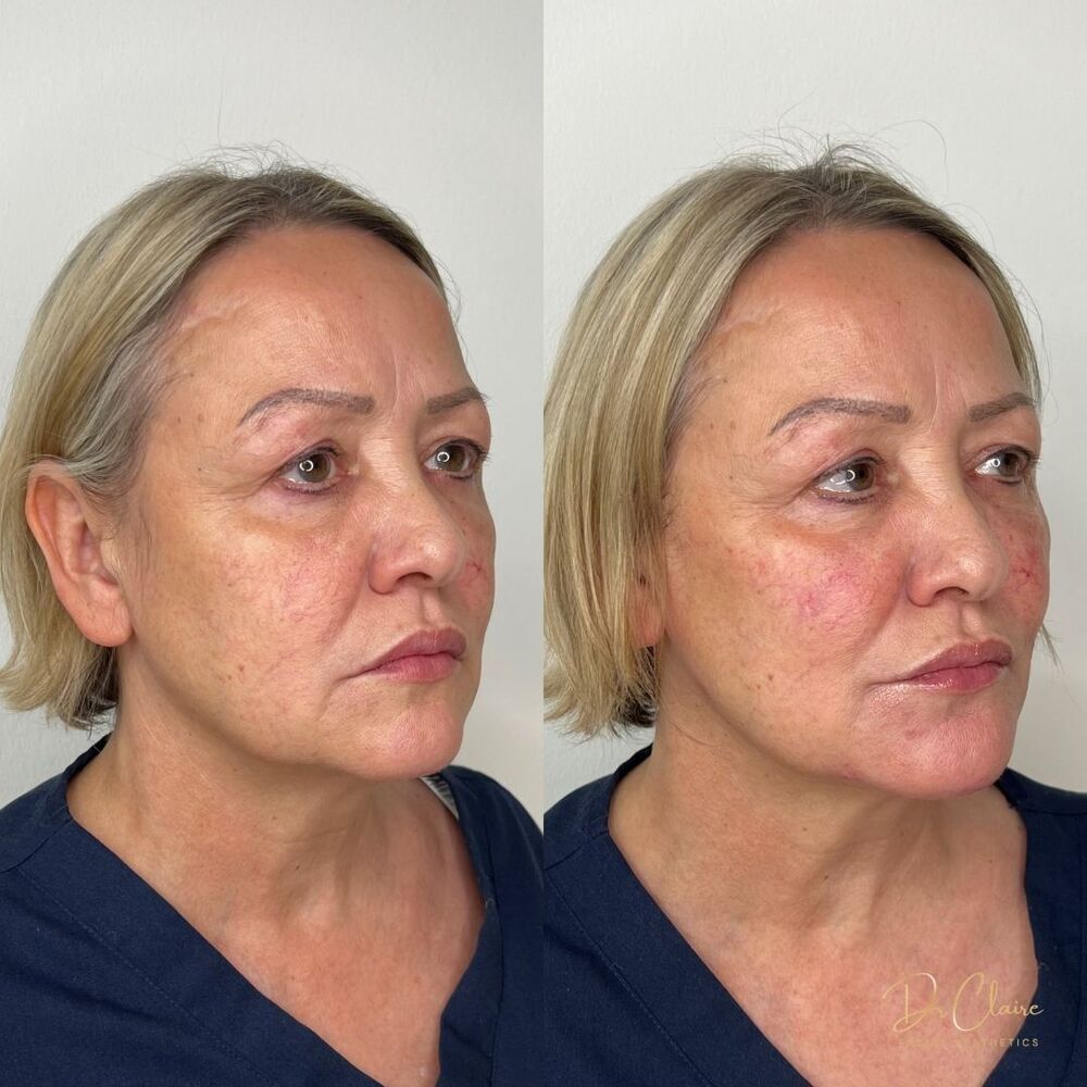 Transformations | Dr Claire Facial Aesthetics | Botox Chorley | Fillers Chorley | Aesthetics Chorley | Botox Treatments Chorley | Dermal Fillers Chorley | Aesthetic Enhancements Chorley