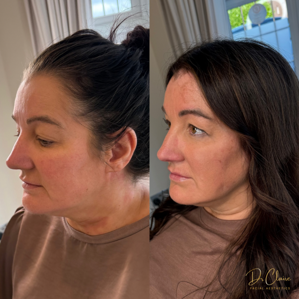 Transformations | Dr Claire Facial Aesthetics | Botox Chorley | Fillers Chorley | Aesthetics Chorley | Botox Treatments Chorley | Dermal Fillers Chorley | Aesthetic Enhancements Chorley