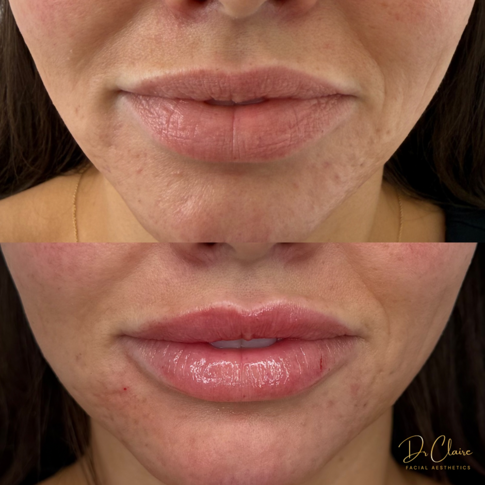 Transformations | Dr Claire Facial Aesthetics | Botox Chorley | Fillers Chorley | Aesthetics Chorley | Botox Treatments Chorley | Dermal Fillers Chorley | Aesthetic Enhancements Chorley