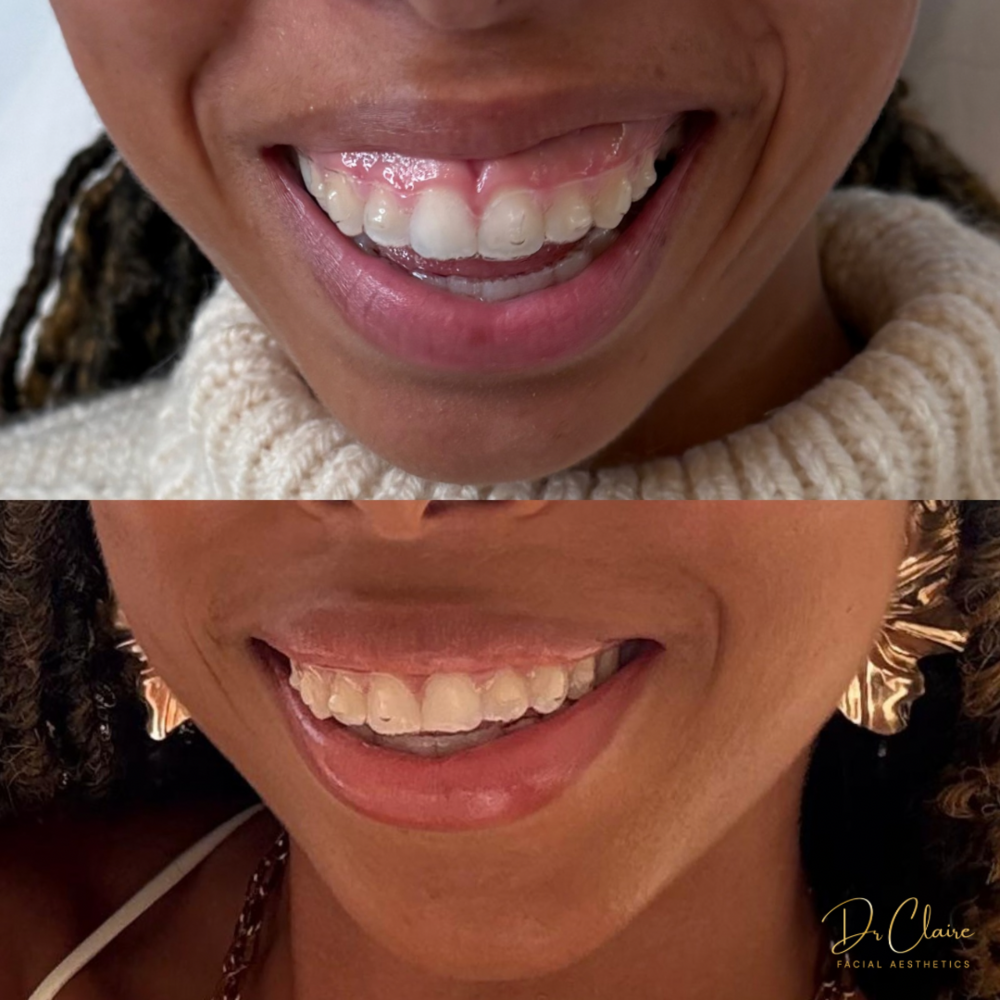 Transformations | Dr Claire Facial Aesthetics | Botox Chorley | Fillers Chorley | Aesthetics Chorley | Botox Treatments Chorley | Dermal Fillers Chorley | Aesthetic Enhancements Chorley