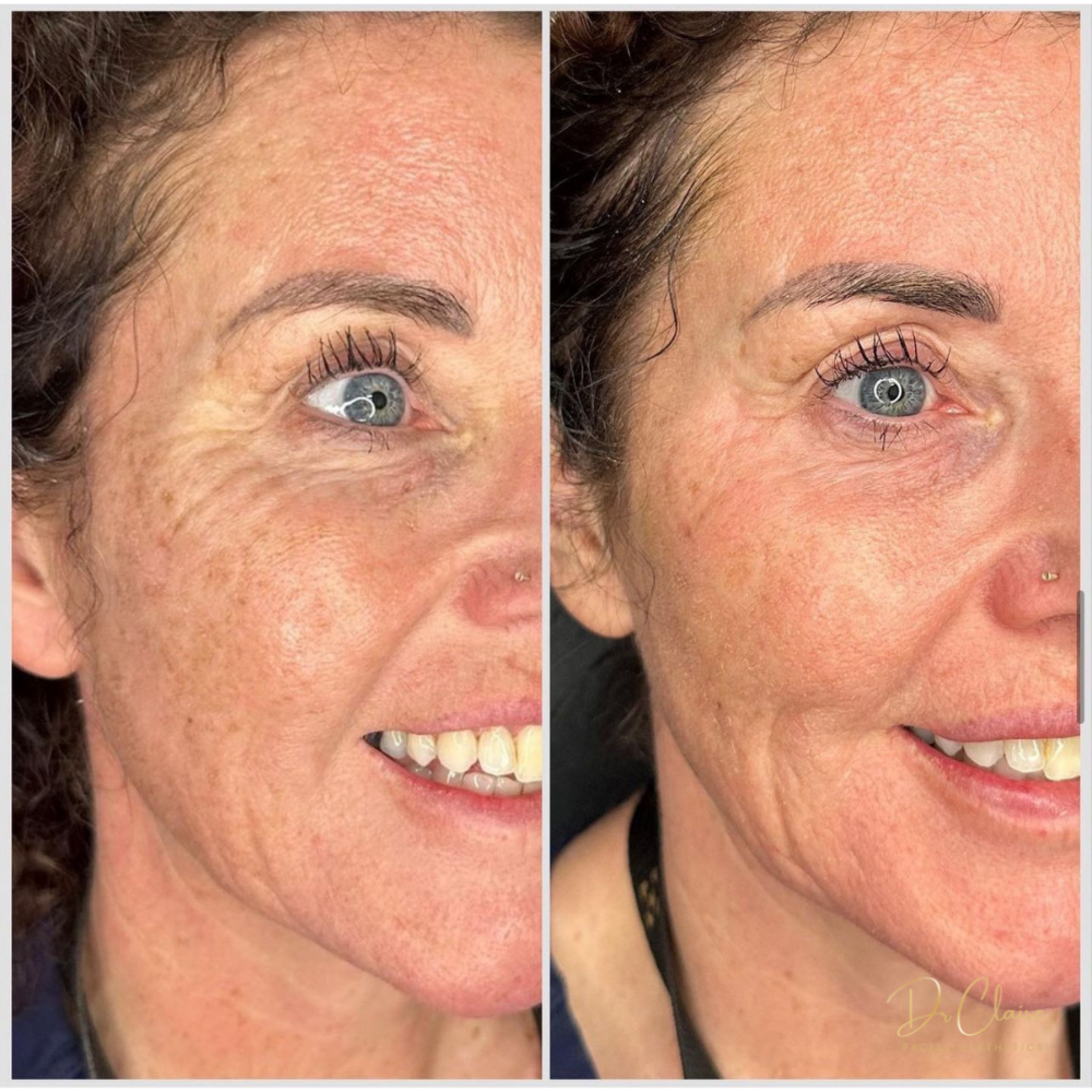 Transformations | Dr Claire Facial Aesthetics | Botox Chorley | Fillers Chorley | Aesthetics Chorley | Botox Treatments Chorley | Dermal Fillers Chorley | Aesthetic Enhancements Chorley
