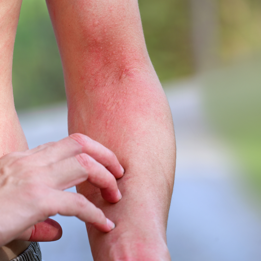 The Multifaceted Nature of Eczema: Unravelling the Underlying Causes