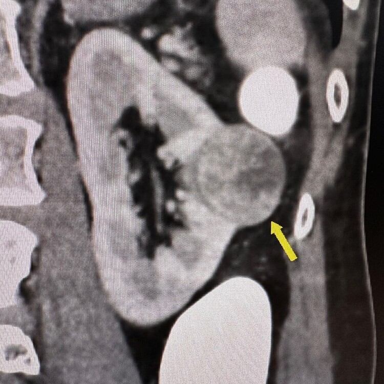 CT Colonography