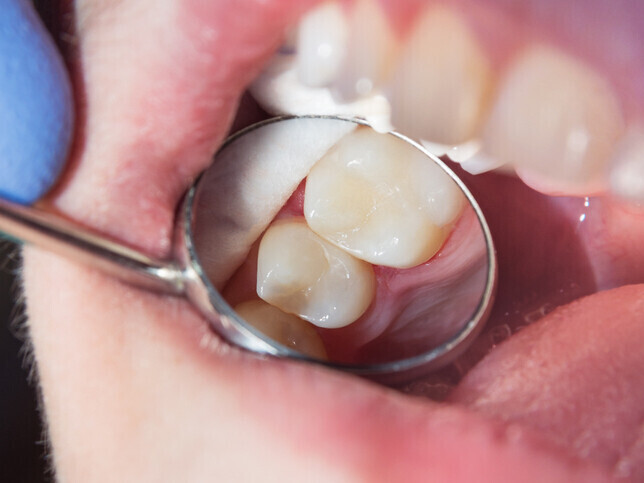 Tooth Wear | Cramond House Dental Practice | Dentist Clitheroe Preston Manchester | Dental Implants Clitheroe Preston Manchester | Gum Surgery Clitheroe Preston Manchester