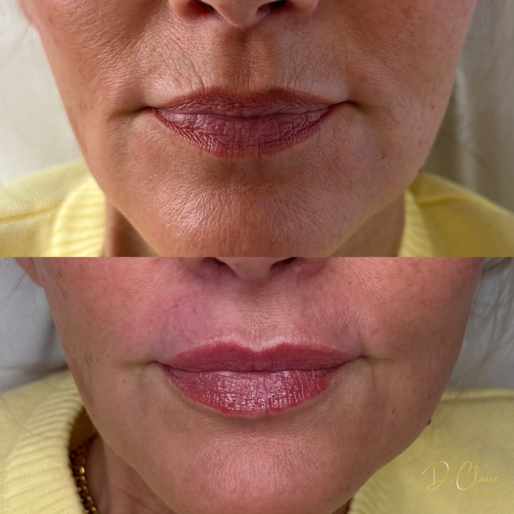 Transformations | Dr Claire Facial Aesthetics | Botox Chorley | Fillers Chorley | Aesthetics Chorley | Botox Treatments Chorley | Dermal Fillers Chorley | Aesthetic Enhancements Chorley