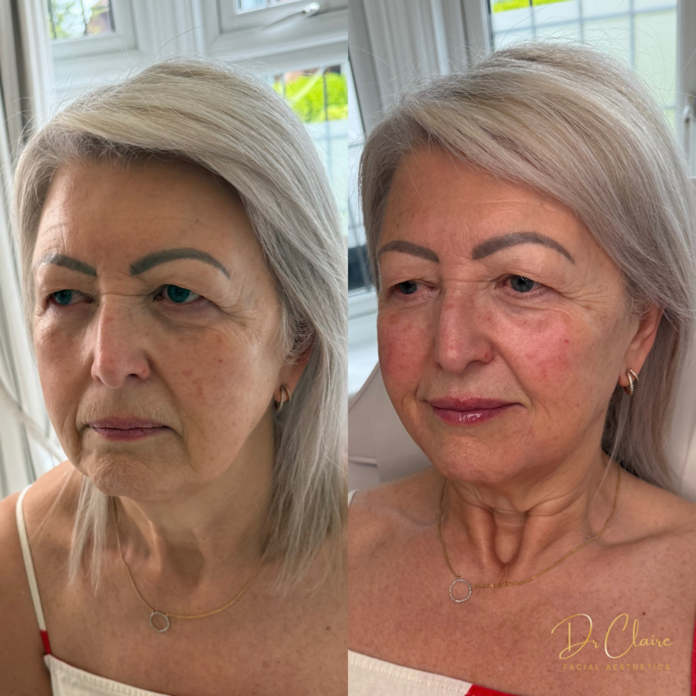 Transformations | Dr Claire Facial Aesthetics | Botox Chorley | Fillers Chorley | Aesthetics Chorley | Botox Treatments Chorley | Dermal Fillers Chorley | Aesthetic Enhancements Chorley