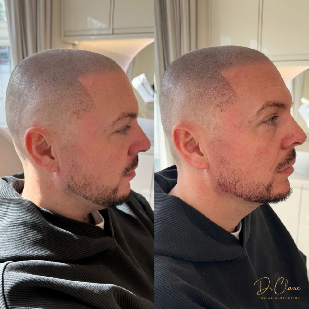 Transformations | Dr Claire Facial Aesthetics | Botox Chorley | Fillers Chorley | Aesthetics Chorley | Botox Treatments Chorley | Dermal Fillers Chorley | Aesthetic Enhancements Chorley