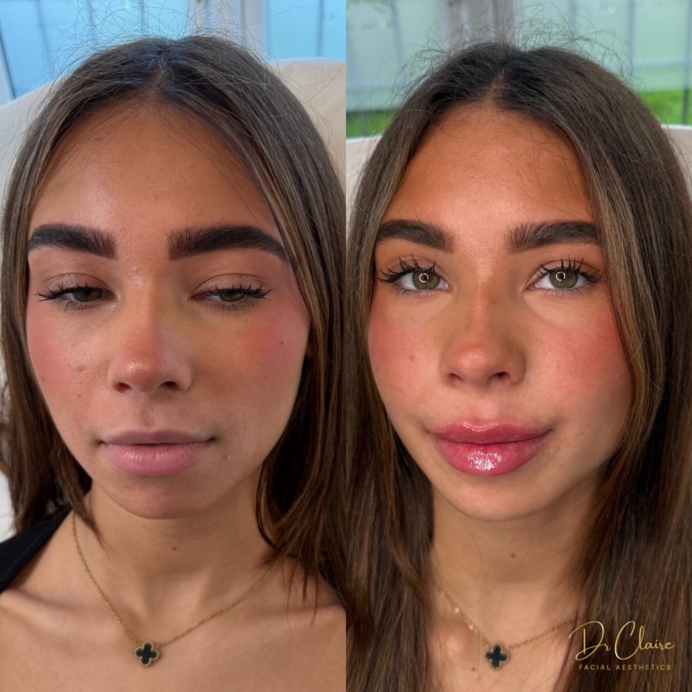Transformations | Dr Claire Facial Aesthetics | Botox Chorley | Fillers Chorley | Aesthetics Chorley | Botox Treatments Chorley | Dermal Fillers Chorley | Aesthetic Enhancements Chorley