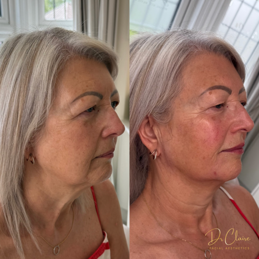 Transformations | Dr Claire Facial Aesthetics | Botox Chorley | Fillers Chorley | Aesthetics Chorley | Botox Treatments Chorley | Dermal Fillers Chorley | Aesthetic Enhancements Chorley
