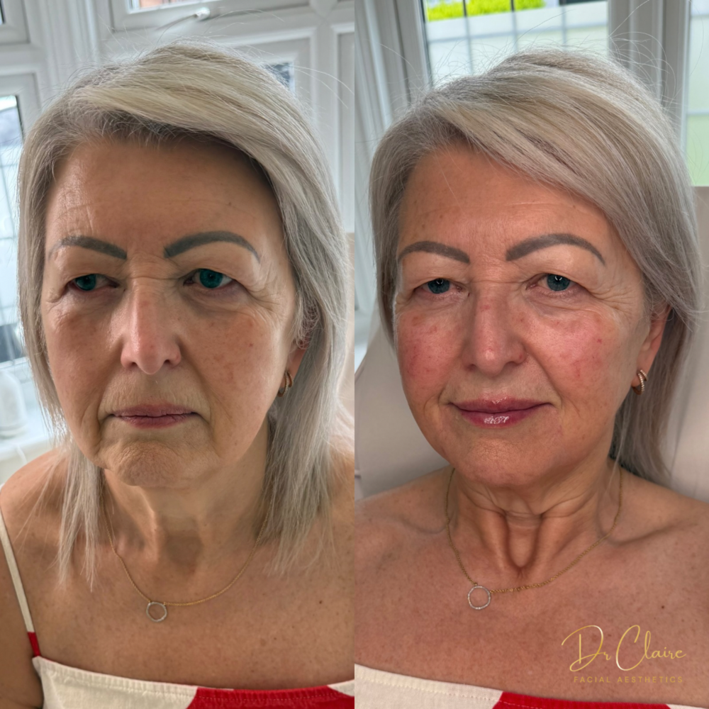 Transformations | Dr Claire Facial Aesthetics | Botox Chorley | Fillers Chorley | Aesthetics Chorley | Botox Treatments Chorley | Dermal Fillers Chorley | Aesthetic Enhancements Chorley