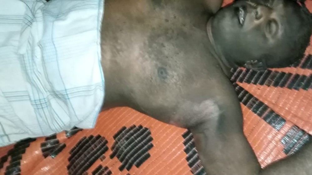 தீ காயங்களுடன் ஆபத்தான நிலையில் வைத்தியசாலையில் அனுமதிக்கப்பட்ட பவானி