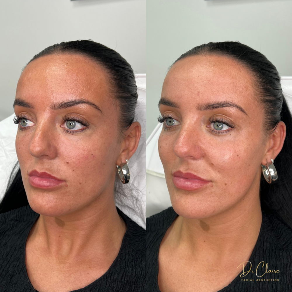 Transformations | Dr Claire Facial Aesthetics | Botox Chorley | Fillers Chorley | Aesthetics Chorley | Botox Treatments Chorley | Dermal Fillers Chorley | Aesthetic Enhancements Chorley