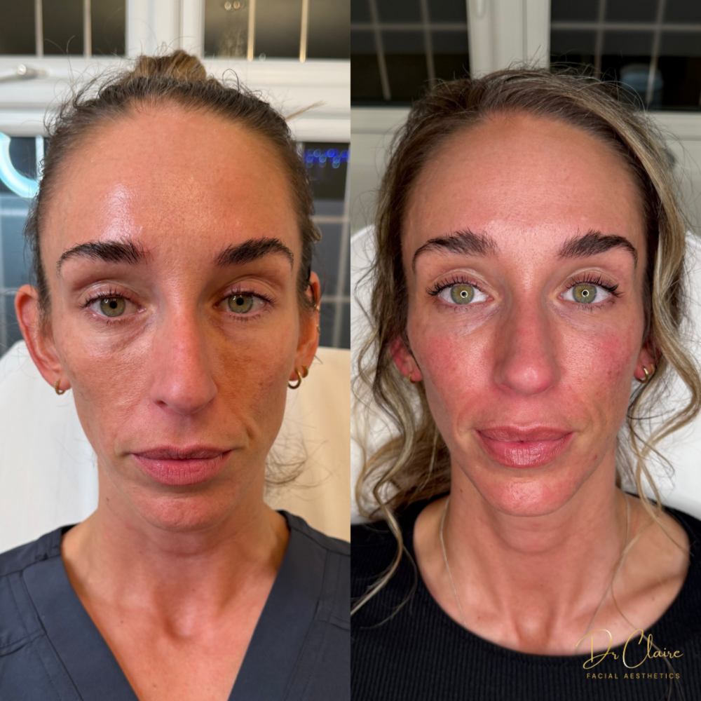 Transformations | Dr Claire Facial Aesthetics | Botox Chorley | Fillers Chorley | Aesthetics Chorley | Botox Treatments Chorley | Dermal Fillers Chorley | Aesthetic Enhancements Chorley