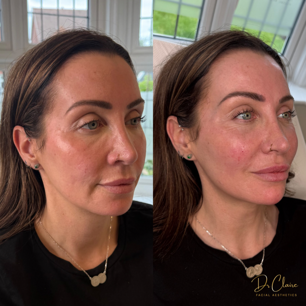 Transformations | Dr Claire Facial Aesthetics | Botox Chorley | Fillers Chorley | Aesthetics Chorley | Botox Treatments Chorley | Dermal Fillers Chorley | Aesthetic Enhancements Chorley