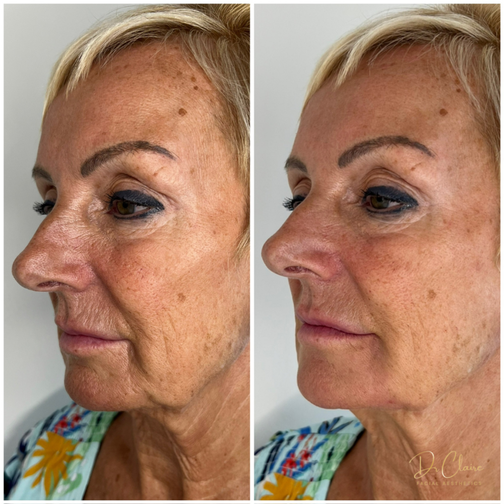 Transformations | Dr Claire Facial Aesthetics | Botox Chorley | Fillers Chorley | Aesthetics Chorley | Botox Treatments Chorley | Dermal Fillers Chorley | Aesthetic Enhancements Chorley