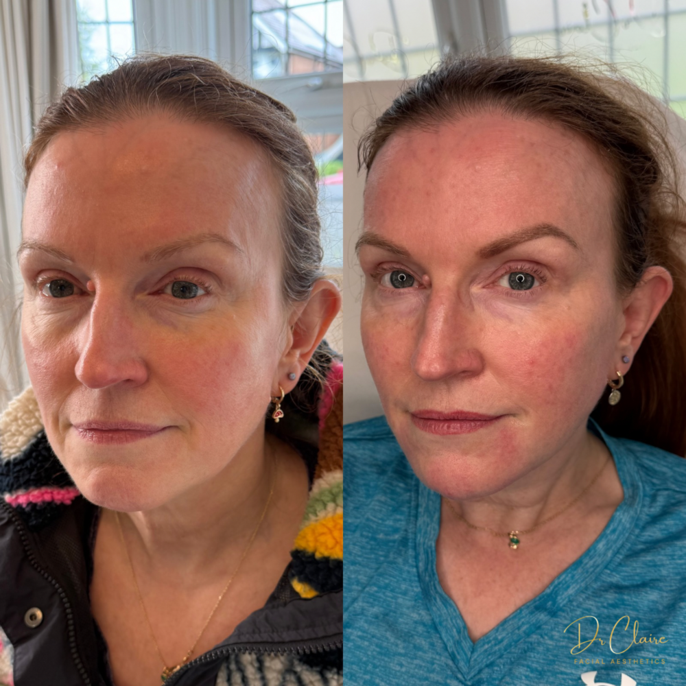 Transformations | Dr Claire Facial Aesthetics | Botox Chorley | Fillers Chorley | Aesthetics Chorley | Botox Treatments Chorley | Dermal Fillers Chorley | Aesthetic Enhancements Chorley