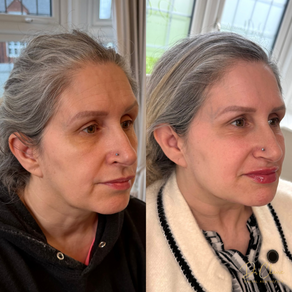 Transformations | Dr Claire Facial Aesthetics | Botox Chorley | Fillers Chorley | Aesthetics Chorley | Botox Treatments Chorley | Dermal Fillers Chorley | Aesthetic Enhancements Chorley