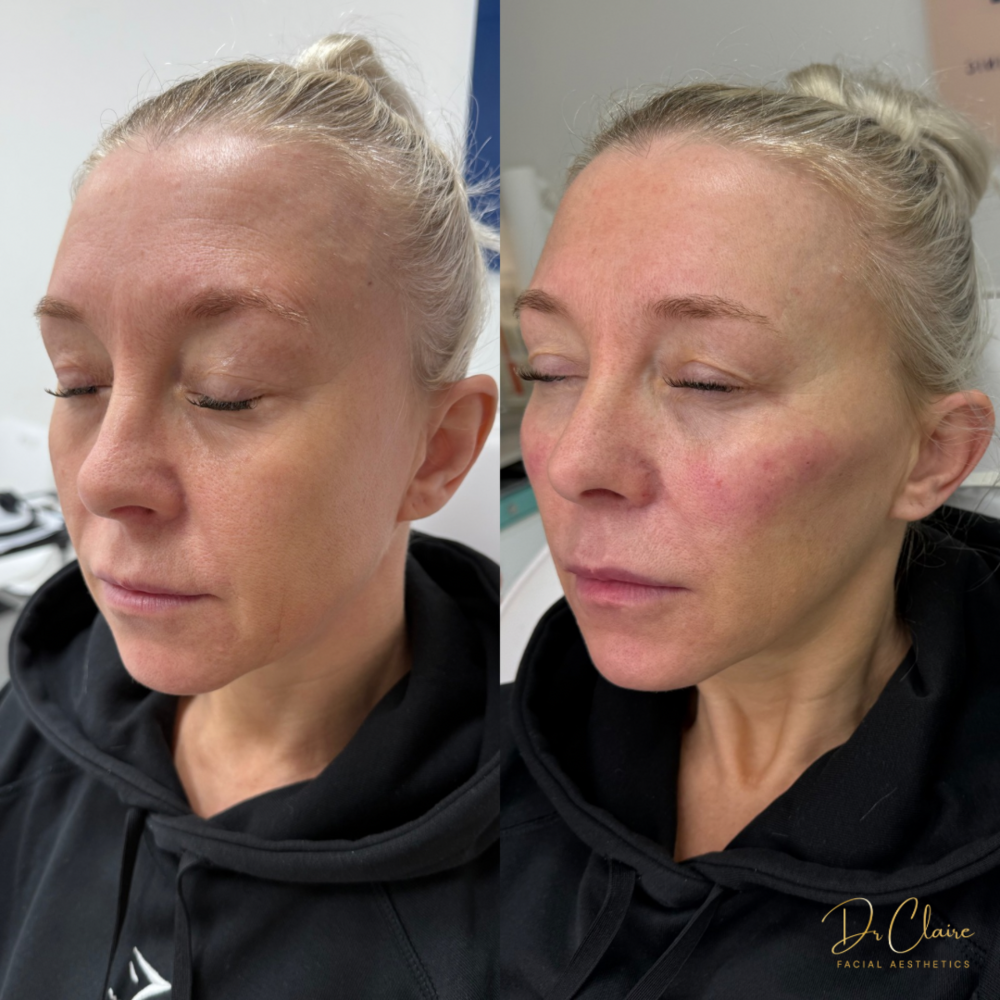 Transformations | Dr Claire Facial Aesthetics | Botox Chorley | Fillers Chorley | Aesthetics Chorley | Botox Treatments Chorley | Dermal Fillers Chorley | Aesthetic Enhancements Chorley