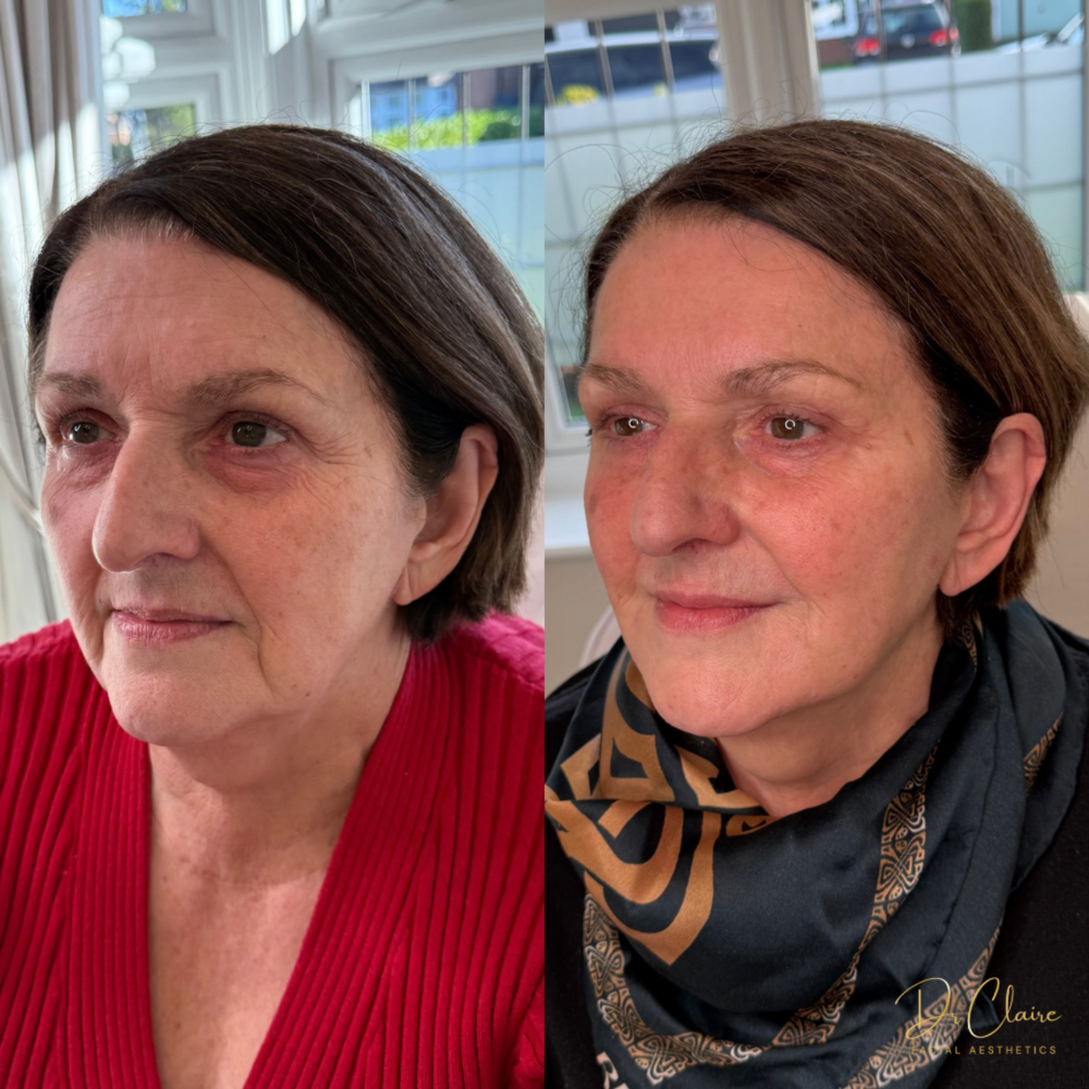 Transformations | Dr Claire Facial Aesthetics | Botox Chorley | Fillers Chorley | Aesthetics Chorley | Botox Treatments Chorley | Dermal Fillers Chorley | Aesthetic Enhancements Chorley