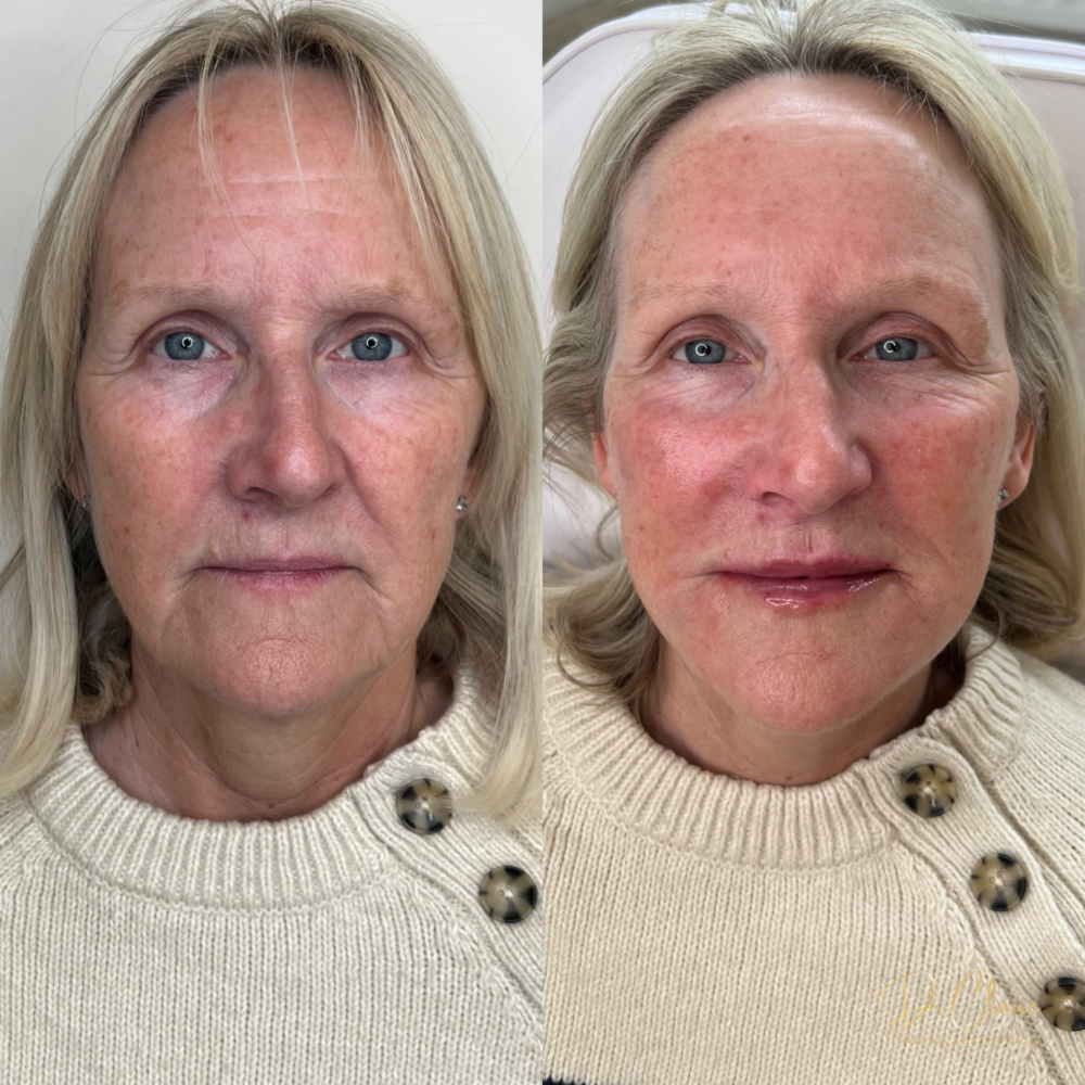 Transformations | Dr Claire Facial Aesthetics | Botox Chorley | Fillers Chorley | Aesthetics Chorley | Botox Treatments Chorley | Dermal Fillers Chorley | Aesthetic Enhancements Chorley