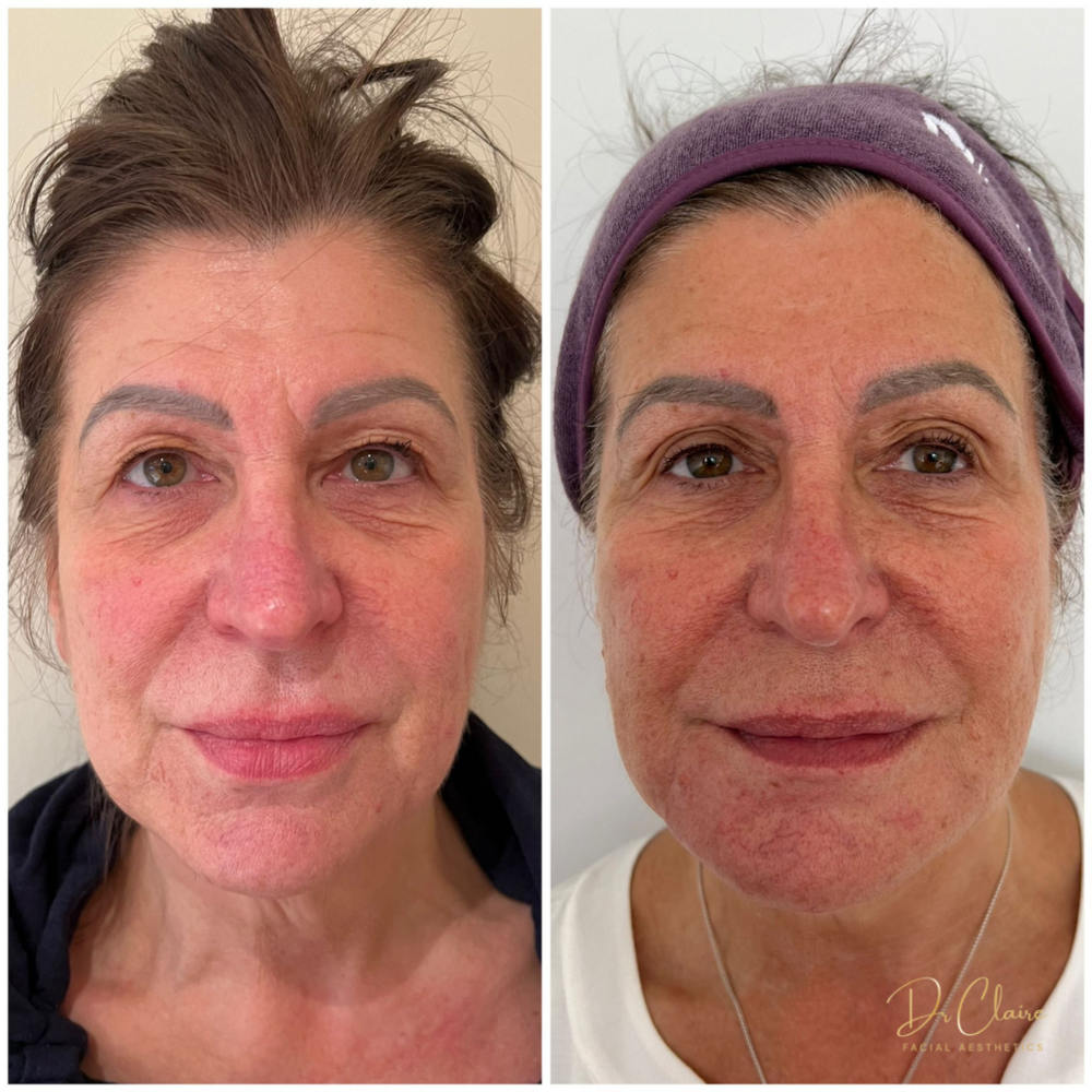 Transformations | Dr Claire Facial Aesthetics | Botox Chorley | Fillers Chorley | Aesthetics Chorley | Botox Treatments Chorley | Dermal Fillers Chorley | Aesthetic Enhancements Chorley
