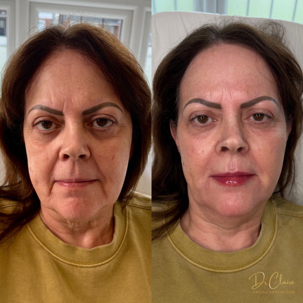 Transformations | Dr Claire Facial Aesthetics | Botox Chorley | Fillers Chorley | Aesthetics Chorley | Botox Treatments Chorley | Dermal Fillers Chorley | Aesthetic Enhancements Chorley