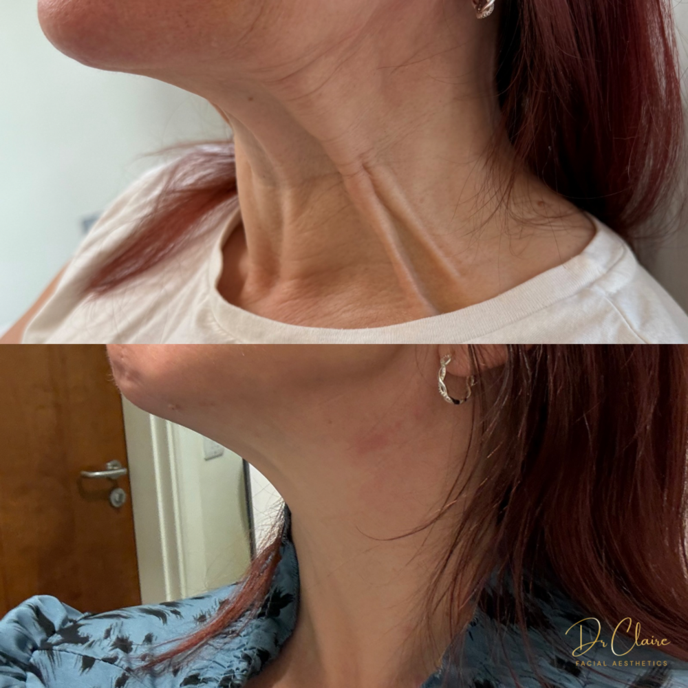 Transformations | Dr Claire Facial Aesthetics | Botox Chorley | Fillers Chorley | Aesthetics Chorley | Botox Treatments Chorley | Dermal Fillers Chorley | Aesthetic Enhancements Chorley