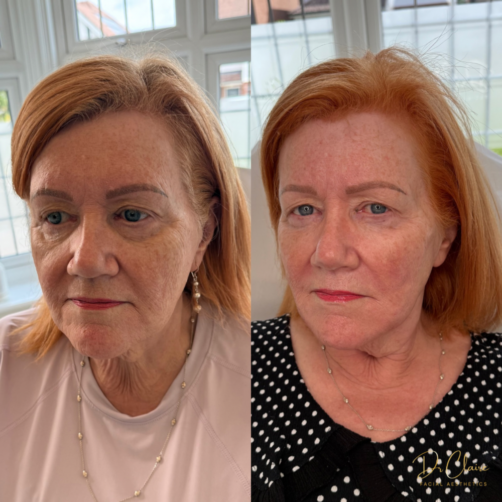 Transformations | Dr Claire Facial Aesthetics | Botox Chorley | Fillers Chorley | Aesthetics Chorley | Botox Treatments Chorley | Dermal Fillers Chorley | Aesthetic Enhancements Chorley