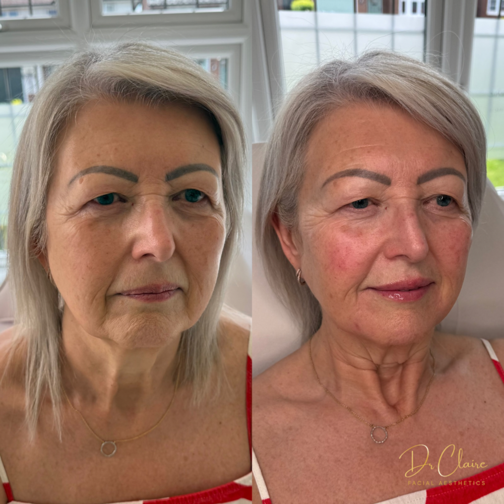Transformations | Dr Claire Facial Aesthetics | Botox Chorley | Fillers Chorley | Aesthetics Chorley | Botox Treatments Chorley | Dermal Fillers Chorley | Aesthetic Enhancements Chorley