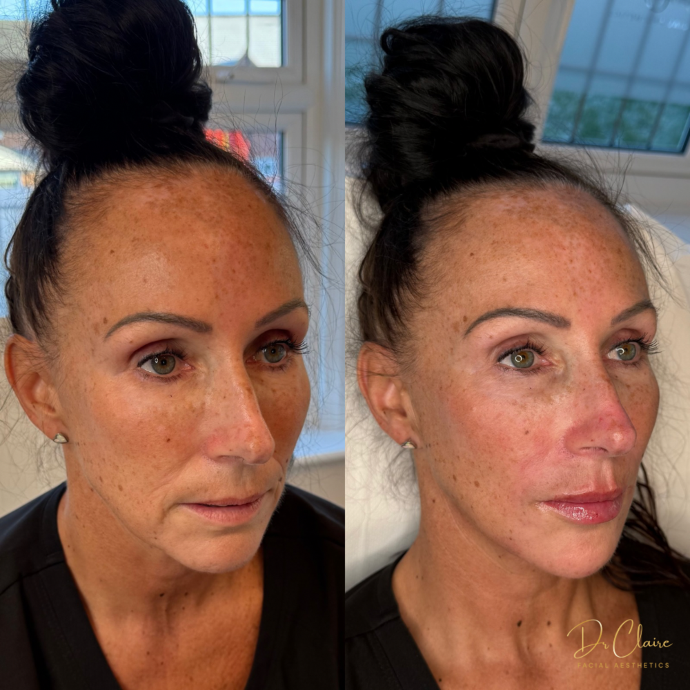 Transformations | Dr Claire Facial Aesthetics | Botox Chorley | Fillers Chorley | Aesthetics Chorley | Botox Treatments Chorley | Dermal Fillers Chorley | Aesthetic Enhancements Chorley
