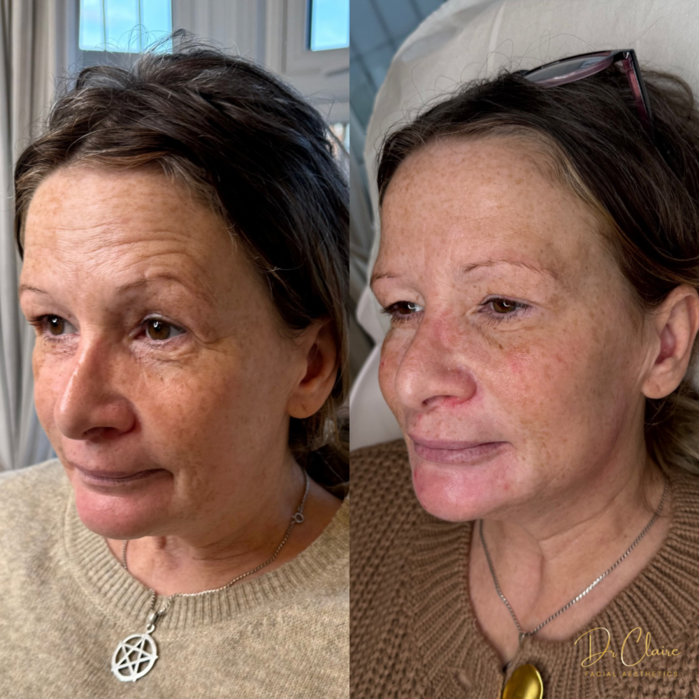 Transformations | Dr Claire Facial Aesthetics | Botox Chorley | Fillers Chorley | Aesthetics Chorley | Botox Treatments Chorley | Dermal Fillers Chorley | Aesthetic Enhancements Chorley