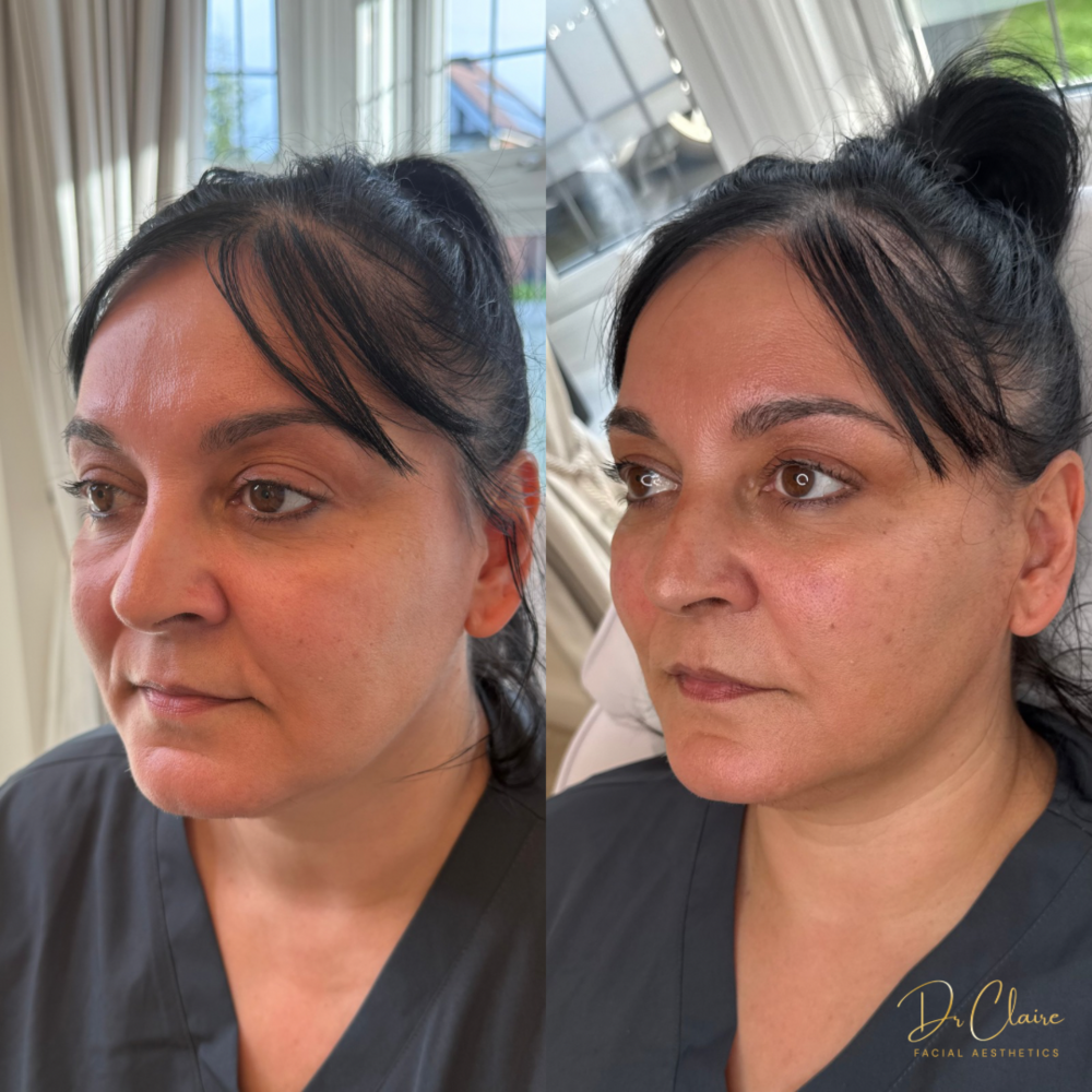 Transformations | Dr Claire Facial Aesthetics | Botox Chorley | Fillers Chorley | Aesthetics Chorley | Botox Treatments Chorley | Dermal Fillers Chorley | Aesthetic Enhancements Chorley
