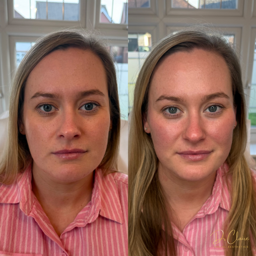 Transformations | Dr Claire Facial Aesthetics | Botox Chorley | Fillers Chorley | Aesthetics Chorley | Botox Treatments Chorley | Dermal Fillers Chorley | Aesthetic Enhancements Chorley