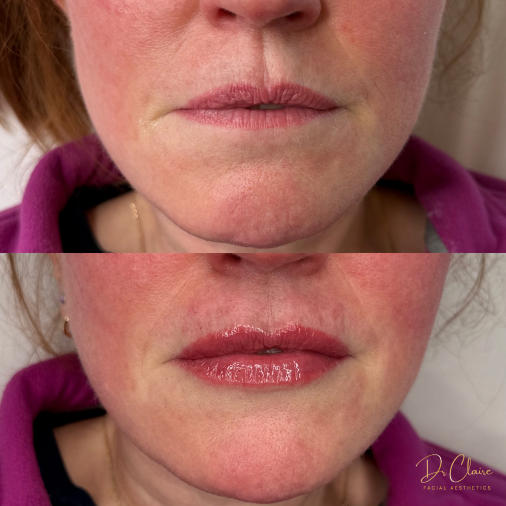Transformations | Dr Claire Facial Aesthetics | Botox Chorley | Fillers Chorley | Aesthetics Chorley | Botox Treatments Chorley | Dermal Fillers Chorley | Aesthetic Enhancements Chorley