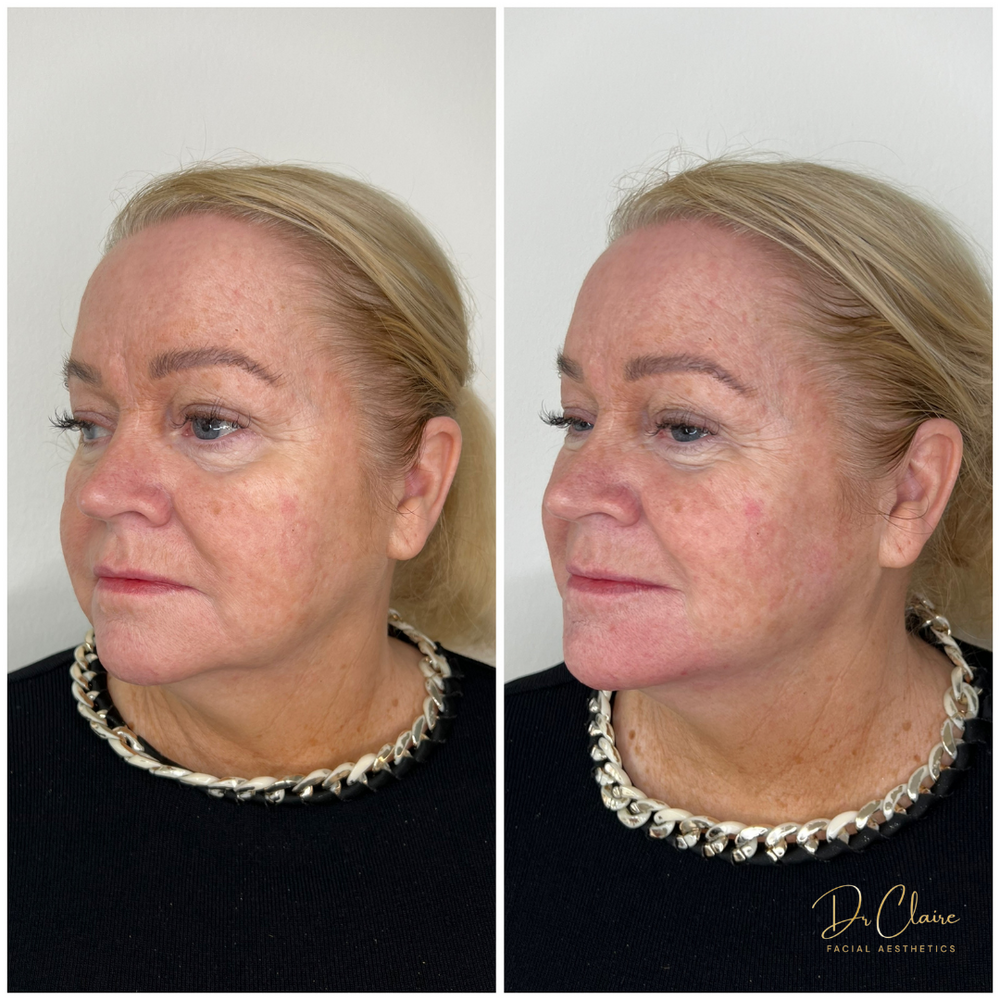 Transformations | Dr Claire Facial Aesthetics | Botox Chorley | Fillers Chorley | Aesthetics Chorley | Botox Treatments Chorley | Dermal Fillers Chorley | Aesthetic Enhancements Chorley