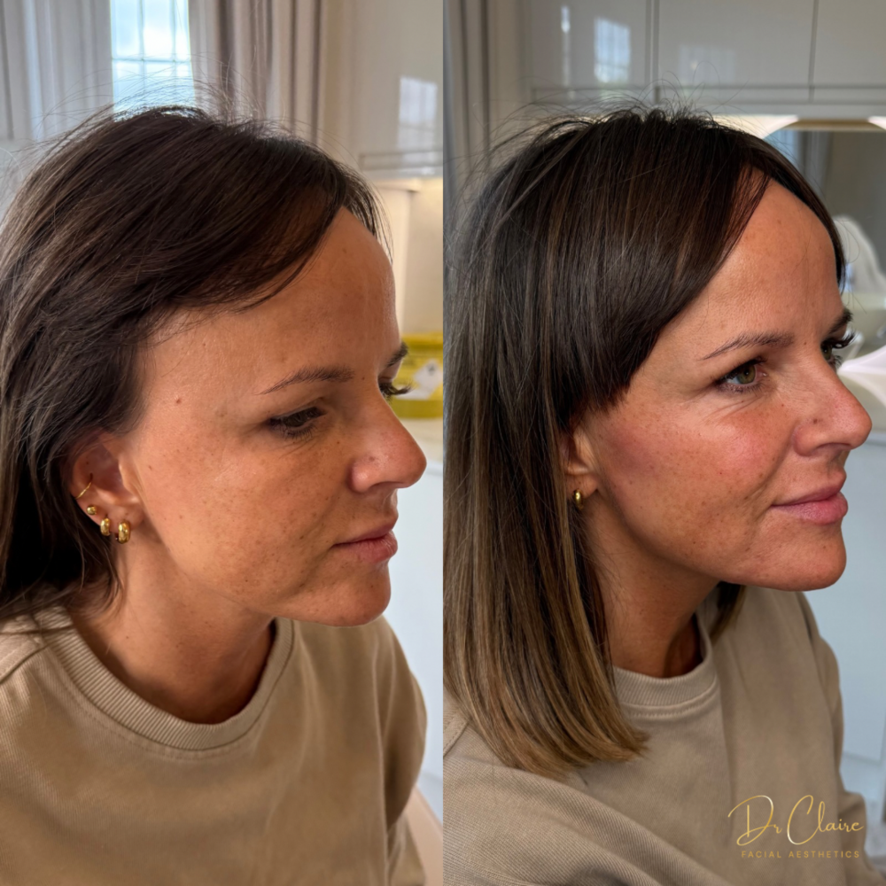 Transformations | Dr Claire Facial Aesthetics | Botox Chorley | Fillers Chorley | Aesthetics Chorley | Botox Treatments Chorley | Dermal Fillers Chorley | Aesthetic Enhancements Chorley