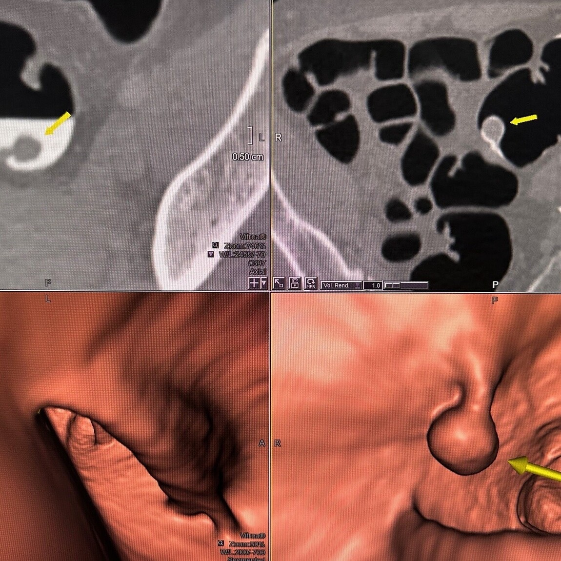 CT Colonography