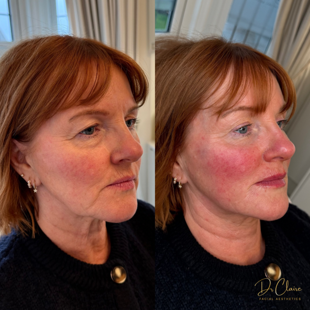Transformations | Dr Claire Facial Aesthetics | Botox Chorley | Fillers Chorley | Aesthetics Chorley | Botox Treatments Chorley | Dermal Fillers Chorley | Aesthetic Enhancements Chorley