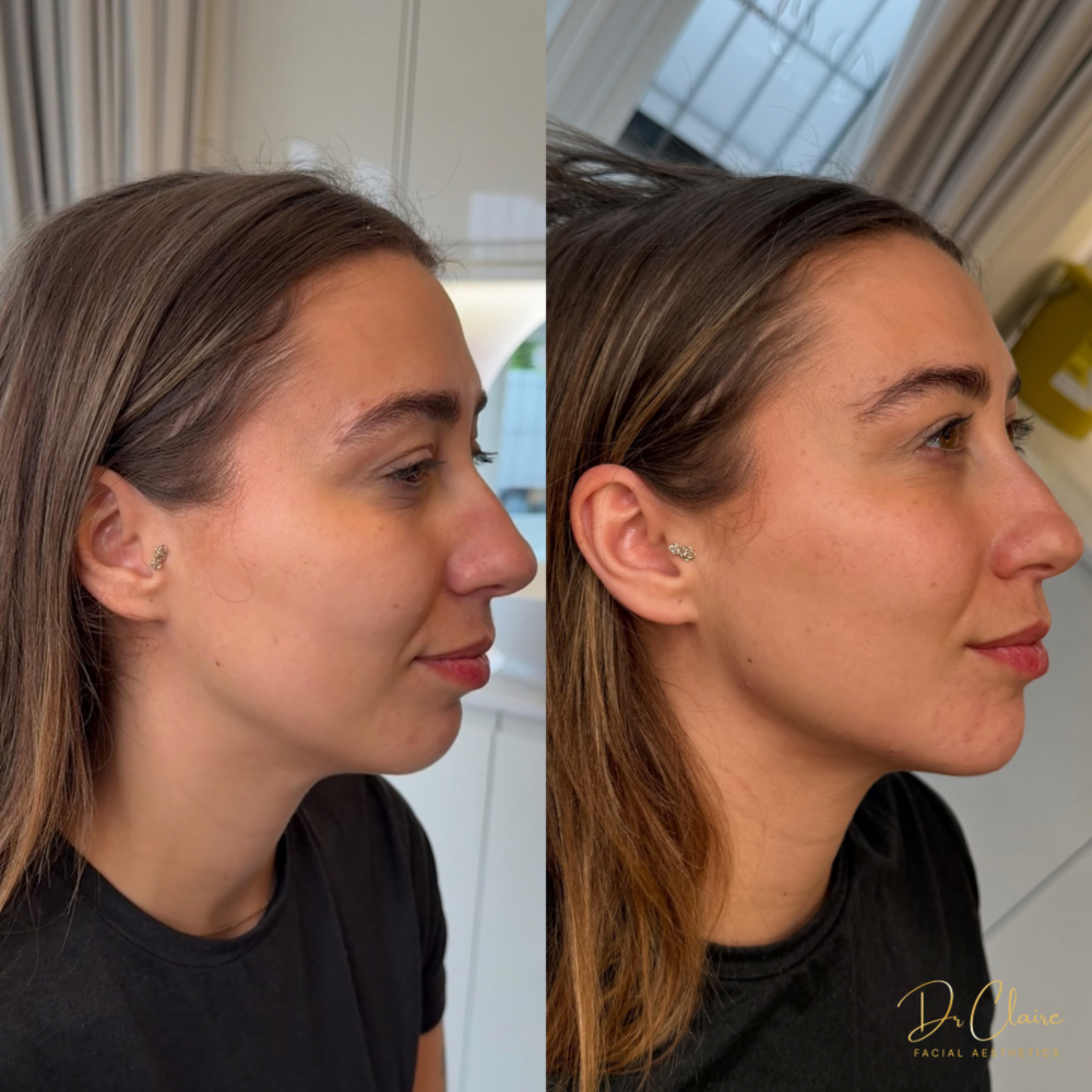 Transformations | Dr Claire Facial Aesthetics | Botox Chorley | Fillers Chorley | Aesthetics Chorley | Botox Treatments Chorley | Dermal Fillers Chorley | Aesthetic Enhancements Chorley