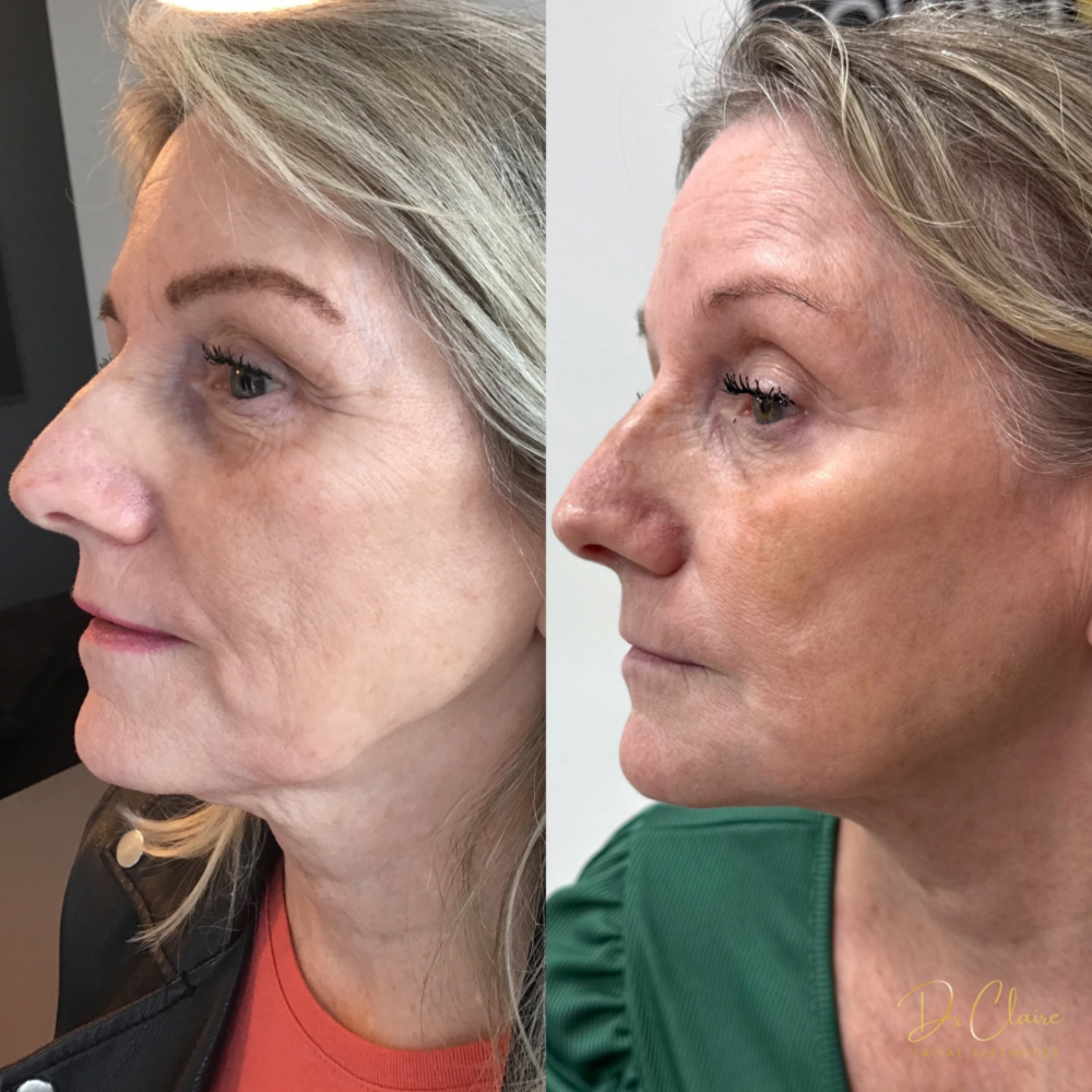 Transformations | Dr Claire Facial Aesthetics | Botox Chorley | Fillers Chorley | Aesthetics Chorley | Botox Treatments Chorley | Dermal Fillers Chorley | Aesthetic Enhancements Chorley