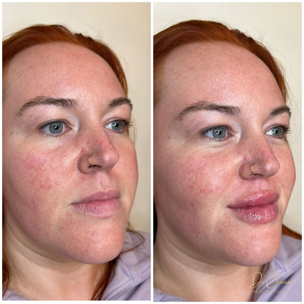 Transformations | Dr Claire Facial Aesthetics | Botox Chorley | Fillers Chorley | Aesthetics Chorley | Botox Treatments Chorley | Dermal Fillers Chorley | Aesthetic Enhancements Chorley