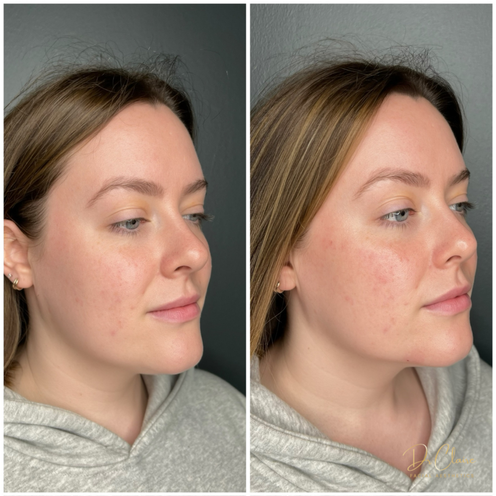 Transformations | Dr Claire Facial Aesthetics | Botox Chorley | Fillers Chorley | Aesthetics Chorley | Botox Treatments Chorley | Dermal Fillers Chorley | Aesthetic Enhancements Chorley