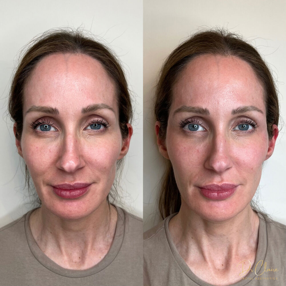Transformations | Dr Claire Facial Aesthetics | Botox Chorley | Fillers Chorley | Aesthetics Chorley | Botox Treatments Chorley | Dermal Fillers Chorley | Aesthetic Enhancements Chorley