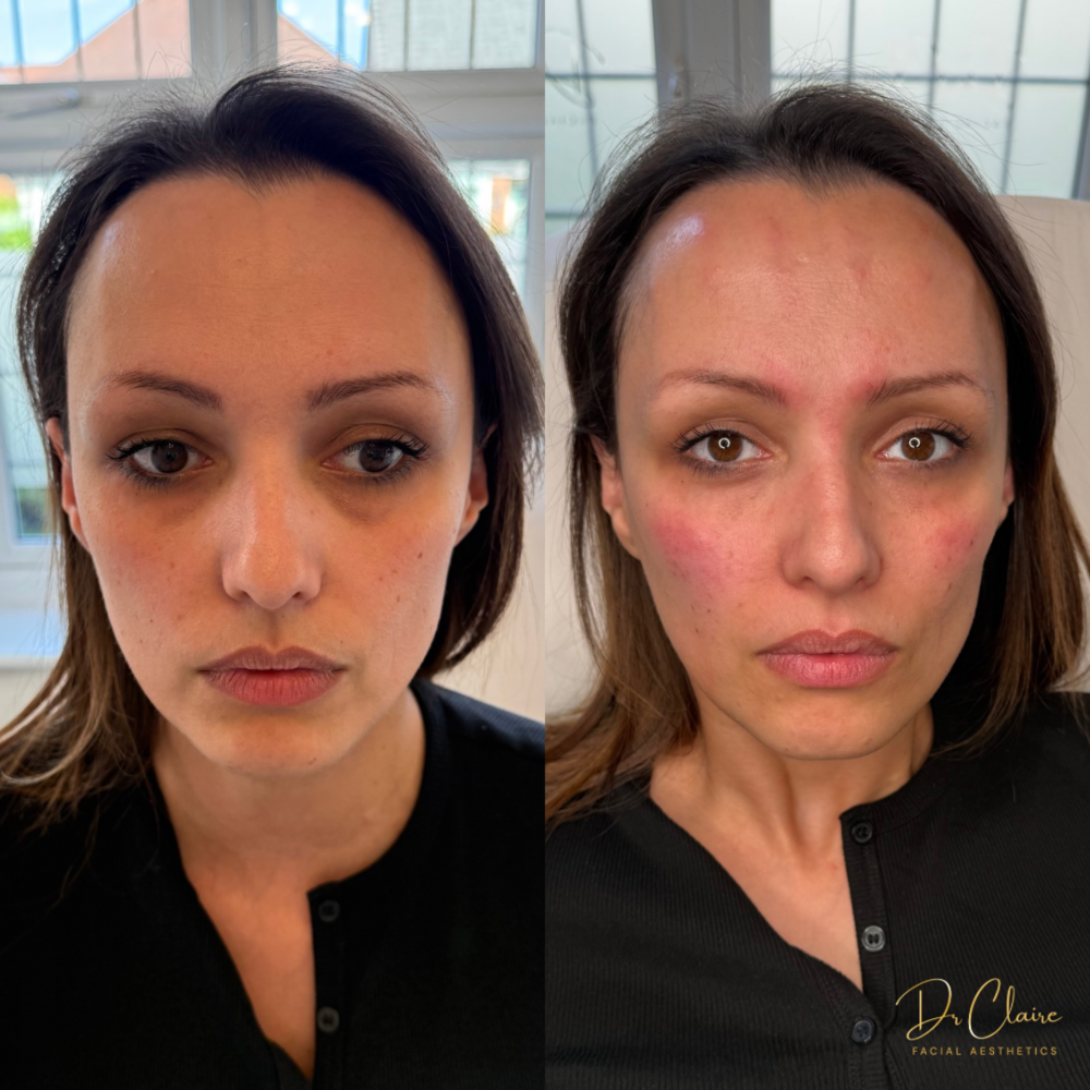 Transformations | Dr Claire Facial Aesthetics | Botox Chorley | Fillers Chorley | Aesthetics Chorley | Botox Treatments Chorley | Dermal Fillers Chorley | Aesthetic Enhancements Chorley