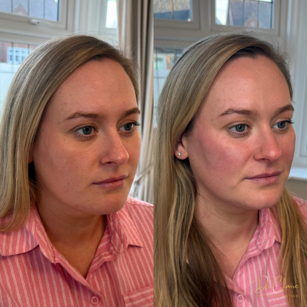 Transformations | Dr Claire Facial Aesthetics | Botox Chorley | Fillers Chorley | Aesthetics Chorley | Botox Treatments Chorley | Dermal Fillers Chorley | Aesthetic Enhancements Chorley