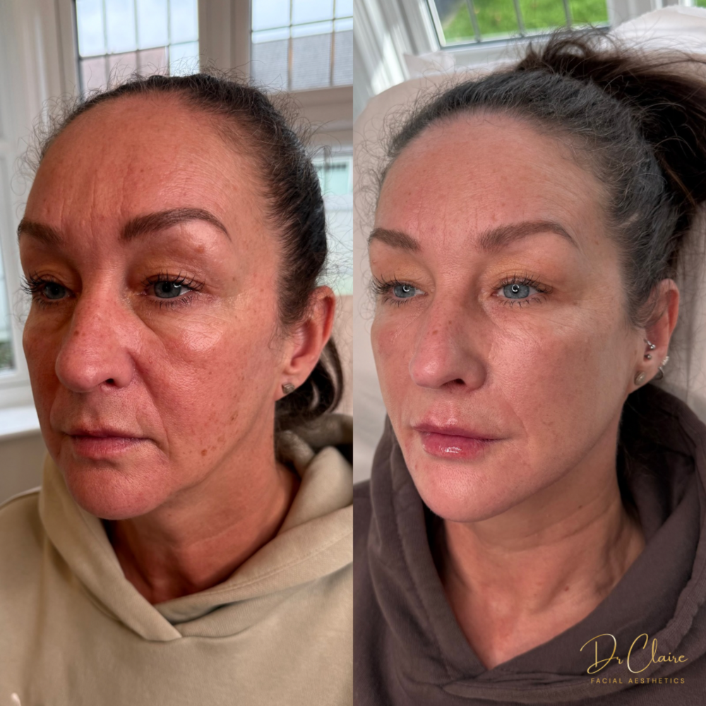 Transformations | Dr Claire Facial Aesthetics | Botox Chorley | Fillers Chorley | Aesthetics Chorley | Botox Treatments Chorley | Dermal Fillers Chorley | Aesthetic Enhancements Chorley