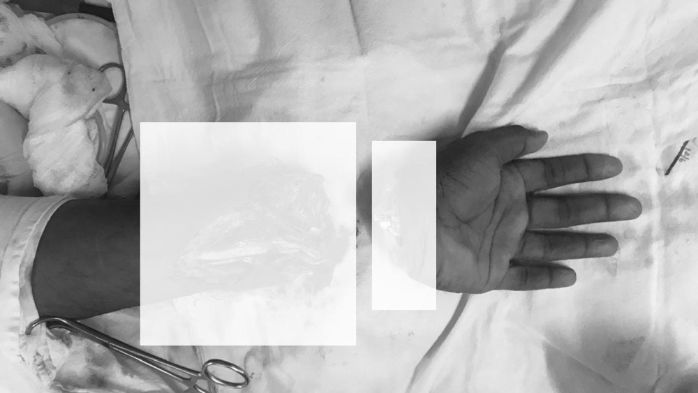 யாழ்.போதனா வைத்தியசாலையின் துண்டிக்கப்பட்ட கை பொருத்தப்பட்டு சாதனை