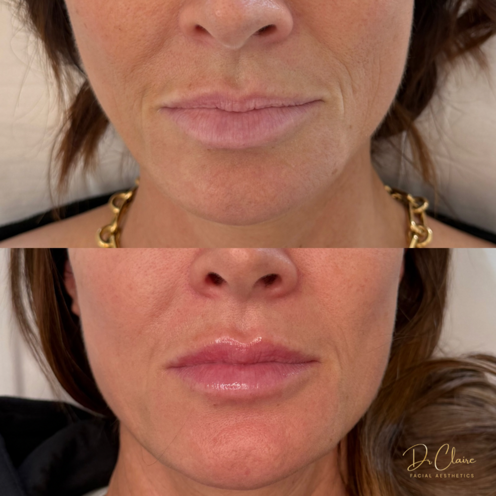 Transformations | Dr Claire Facial Aesthetics | Botox Chorley | Fillers Chorley | Aesthetics Chorley | Botox Treatments Chorley | Dermal Fillers Chorley | Aesthetic Enhancements Chorley